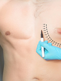 Gynécomastie : objectifs, indications et remboursement de la chirurgie de la poitrine masculine