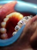Quels sont les avantages et les inconvénients de l’orthodontie accélérée