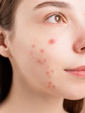 Bouton rouge sur le visage : causes et solutions à explorer
